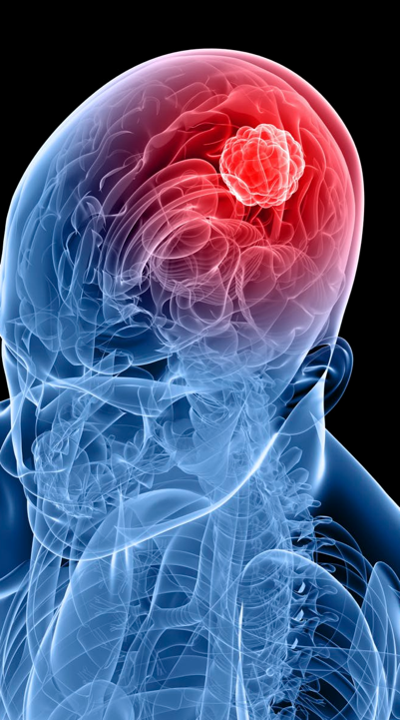 GLIOBLASTOMA in SiNON